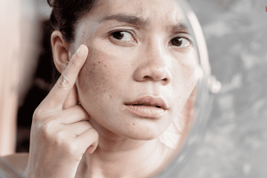 Melasma in Pregnancy: Treatment and Causes