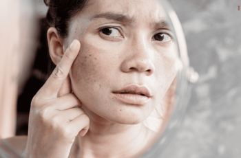 Melasma in Pregnancy: Treatment and Causes